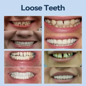 SmileFitPro® – 𝐌𝐞𝐝𝐢𝐜𝐚𝐥𝐅𝐢𝐭 𝐀𝐝𝐚𝐩𝐭𝐢𝐯𝐞 𝐃𝐞𝐧𝐭𝐮𝐫𝐞𝐬🦷Suitable for all mouth shapes, perfect fit🦷(⏰Limited time 50% off, last 30 minutes⏰)
