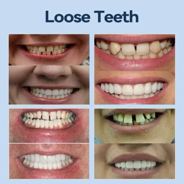 SmileFitPro® – 𝐌𝐞𝐝𝐢𝐜𝐚𝐥𝐅𝐢𝐭 𝐀𝐝𝐚𝐩𝐭𝐢𝐯𝐞 𝐃𝐞𝐧𝐭𝐮𝐫𝐞𝐬🦷Suitable for all mouth shapes, perfect fit🦷(⏰Limited time 50% off, last 30 minutes⏰)