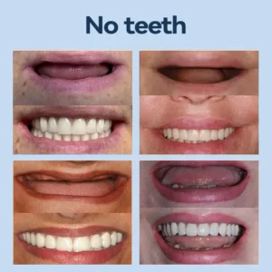 SmileFitPro® – 𝐌𝐞𝐝𝐢𝐜𝐚𝐥𝐅𝐢𝐭 𝐀𝐝𝐚𝐩𝐭𝐢𝐯𝐞 𝐃𝐞𝐧𝐭𝐮𝐫𝐞𝐬🦷Suitable for all mouth shapes, perfect fit🦷(⏰Limited time 50% off, last 30 minutes⏰)