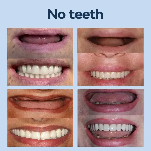SmileFitPro® – 𝐌𝐞𝐝𝐢𝐜𝐚𝐥𝐅𝐢𝐭 𝐀𝐝𝐚𝐩𝐭𝐢𝐯𝐞 𝐃𝐞𝐧𝐭𝐮𝐫𝐞𝐬🦷Suitable for all mouth shapes, perfect fit🦷(⏰Limited time 50% off, last 30 minutes⏰)