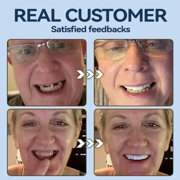SmileFitPro® – 𝐌𝐞𝐝𝐢𝐜𝐚𝐥𝐅𝐢𝐭 𝐀𝐝𝐚𝐩𝐭𝐢𝐯𝐞 𝐃𝐞𝐧𝐭𝐮𝐫𝐞𝐬🦷Suitable for all mouth shapes, perfect fit🦷(⏰Limited time 50% off, last 30 minutes⏰)