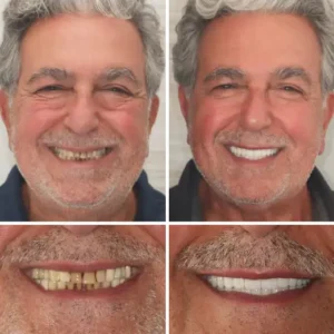 【Official Brand Store】Custom-Fit Functional Dentures