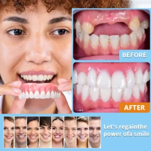 【Official Brand Store】Custom-Fit Functional Dentures