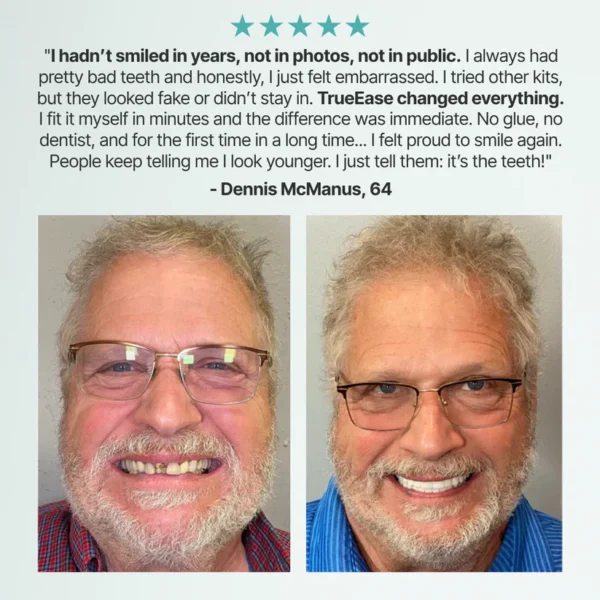 SmileCraft™ Custom-Fit Functional Dentures