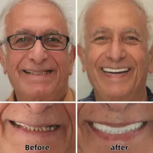 SmileFitPro™-Advanced Custom-Fit Functional Dentures