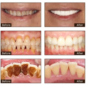 SmileFitPro™ Niacinamide Whitening Toothpaste