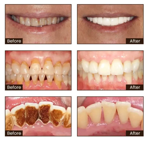 SmileFitPro™ Niacinamide Whitening Toothpaste