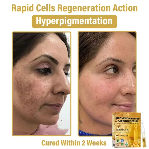 𝐃𝒚𝐜𝐞𝐜𝐨®🥑 𝑩𝒆𝐞 𝑽𝐞𝒏𝒐𝒎 𝑺𝒌𝒊𝒏 𝑹𝐞𝒑𝒂𝒊𝒓 𝑨𝒎𝒑𝒐𝒖𝒍𝐞 𝑺𝐞𝒓𝒖𝒎 (👨‍⚕𝑵𝑷𝑭 𝑹𝑬𝑪𝑶𝑴𝑴𝑬𝑵𝑫𝑺)