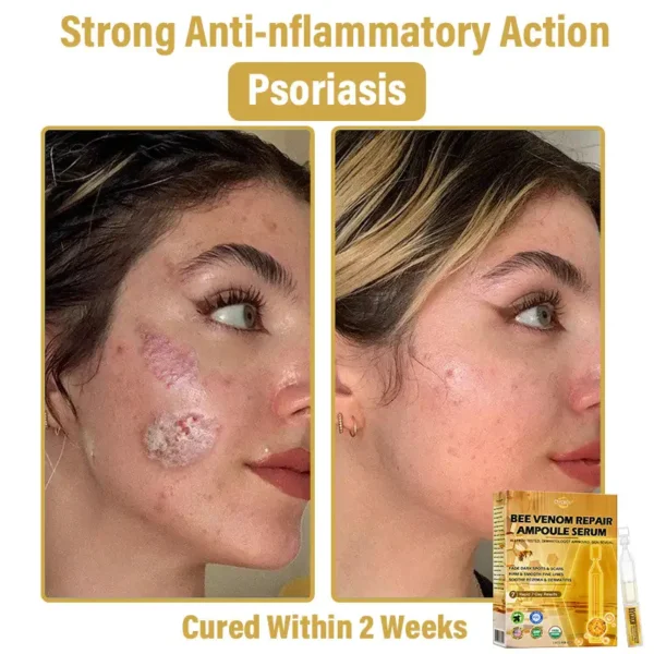 𝐃𝒚𝐜𝐞𝐜𝐨®🥑 𝑩𝒆𝐞 𝑽𝐞𝒏𝒐𝒎 𝑺𝒌𝒊𝒏 𝑹𝐞𝒑𝒂𝒊𝒓 𝑨𝒎𝒑𝒐𝒖𝒍𝐞 𝑺𝐞𝒓𝒖𝒎 (👨‍⚕𝑵𝑷𝑭 𝑹𝑬𝑪𝑶𝑴𝑴𝑬𝑵𝑫𝑺)