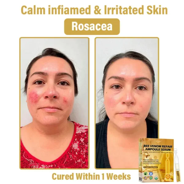 𝐃𝒚𝐜𝐞𝐜𝐨®🥑 𝑩𝒆𝐞 𝑽𝐞𝒏𝒐𝒎 𝑺𝒌𝒊𝒏 𝑹𝐞𝒑𝒂𝒊𝒓 𝑨𝒎𝒑𝒐𝒖𝒍𝐞 𝑺𝐞𝒓𝒖𝒎 (👨‍⚕𝑵𝑷𝑭 𝑹𝑬𝑪𝑶𝑴𝑴𝑬𝑵𝑫𝑺)