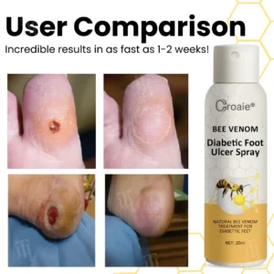 🌟 Official Store | Croaie® Bee Venom Diabetic Foot Ulcer Spray