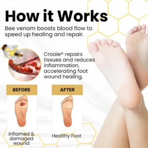 🌟 Official Store | Croaie® Bee Venom Diabetic Foot Ulcer Spray