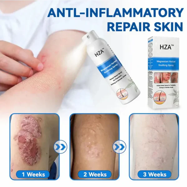 HZA™ Magnesium Herbal Psoriasis Spray