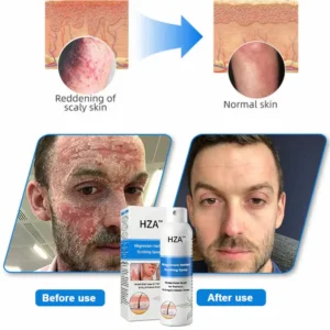 HZA™ Magnesium Herbal Psoriasis Spray