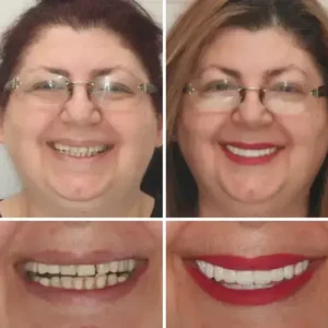 INSIDEEFY™ –🦷Advanced Customized Full Denture Set🦷 {Developed by Harvard University}