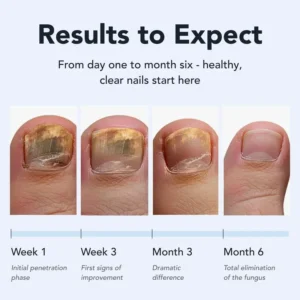 Juxek Toenail Fungus Pen - UNDECYLENIC ACID 25% - Daily Solution for Brittle & Thickened Nails