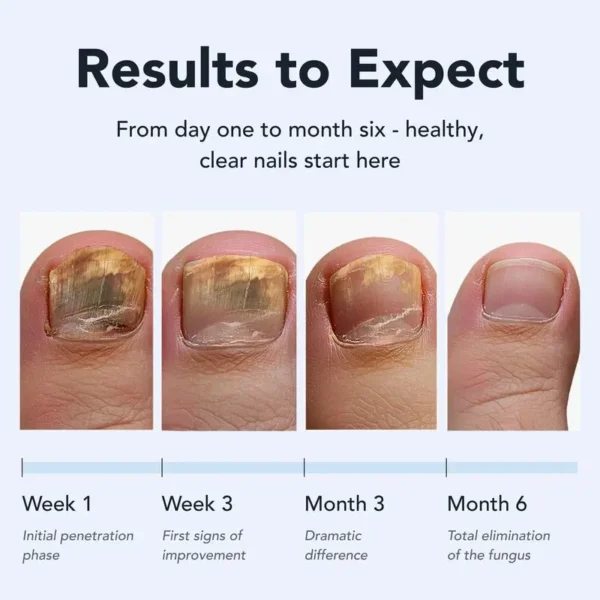 Juxek Toenail Fungus Pen - UNDECYLENIC ACID 25% - Daily Solution for Brittle & Thickened Nails