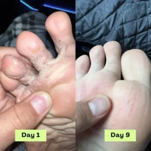 NEGUSY™ Tea Tree Athlete's Foot Defense Soap