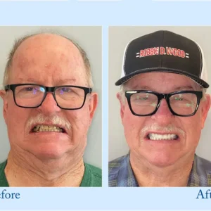 NESLEMY™ Custom-Fit Functional Dentures - Perfectly Fitted in Minutes at Home