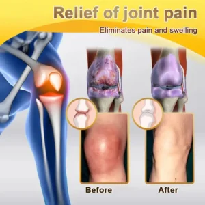 PolarFresh® Bee Venom & Botulinum Toxin Joint Pain Relief & Repair Cream– Fast Relief & Joint Repair