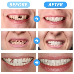 🦷SmileFitPro™ Instant Tooth Repair Gel – No Drills, No Pain, Fast at Home Fix!