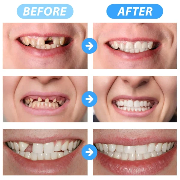 🦷SmileFitPro™ Instant Tooth Repair Gel – No Drills, No Pain, Fast at Home Fix!