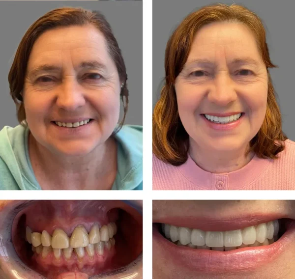 🦷SmileFitPro™ Instant Tooth Repair Gel – No Drills, No Pain, Fast at Home Fix!