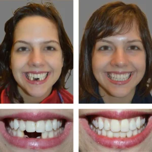 🦷SmileFitPro™ Instant Tooth Repair Gel – No Drills, No Pain, Fast at Home Fix!