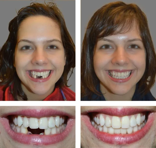 🦷SmileFitPro™ Instant Tooth Repair Gel – No Drills, No Pain, Fast at Home Fix!