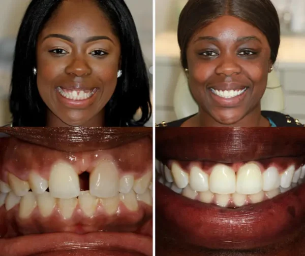 🦷SmileFitPro™ Instant Tooth Repair Gel – No Drills, No Pain, Fast at Home Fix!