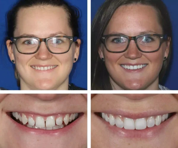 🦷SmileFitPro™ Instant Tooth Repair Gel – No Drills, No Pain, Fast at Home Fix!