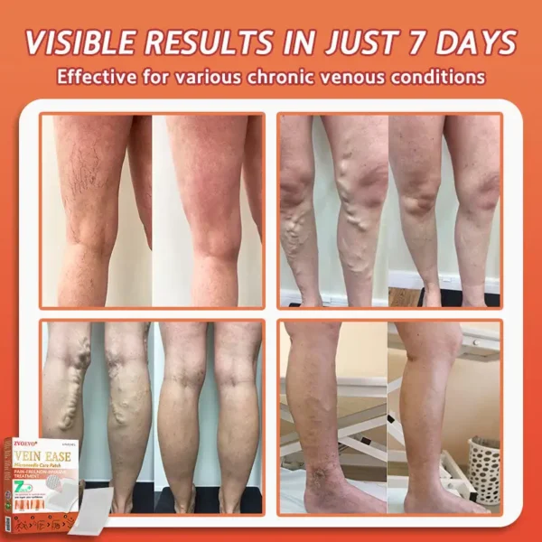 🎁💐Zvoevo® Vein Ease Microneedle Care Patch(For Spider Veins, Varicose Veins, Swelling & Leg Fatigue)
