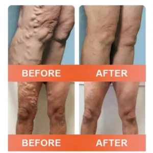 🎁💐Zvoevo® Vein Ease Microneedle Care Patch(For Spider Veins, Varicose Veins, Swelling & Leg Fatigue)