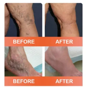 🎁💐Zvoevo® Vein Ease Microneedle Care Patch(For Spider Veins, Varicose Veins, Swelling & Leg Fatigue)