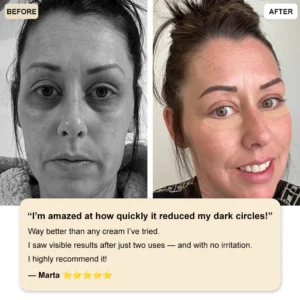 ✅Official Store: Zvoevo® Deep Precision Age-Defying Nano Microneedle Patches - Deep-acting solution for tackling under-eye bags, dark circles, laughter lines, forehead lines, and all those other pesky facial wrinkles.