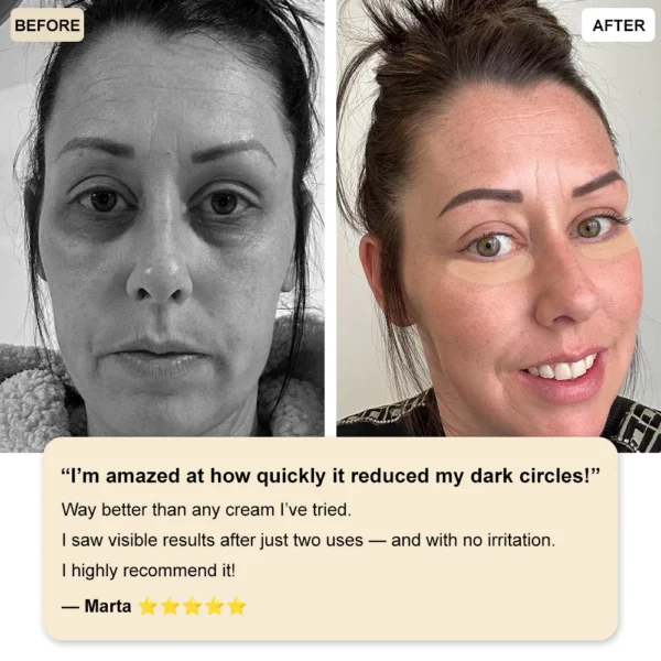 ✅Official Store: Zvoevo® Deep Precision Age-Defying Nano Microneedle Patches - Deep-acting solution for tackling under-eye bags, dark circles, laughter lines, forehead lines, and all those other pesky facial wrinkles.