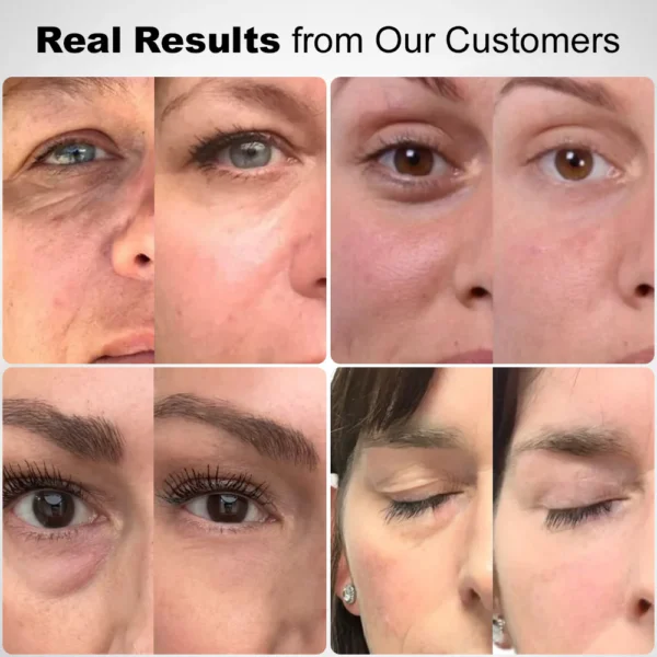 ✅Official Store: Zvoevo® Deep Precision Age-Defying Nano Microneedle Patches - Deep-acting solution for tackling under-eye bags, dark circles, laughter lines, forehead lines, and all those other pesky facial wrinkles.