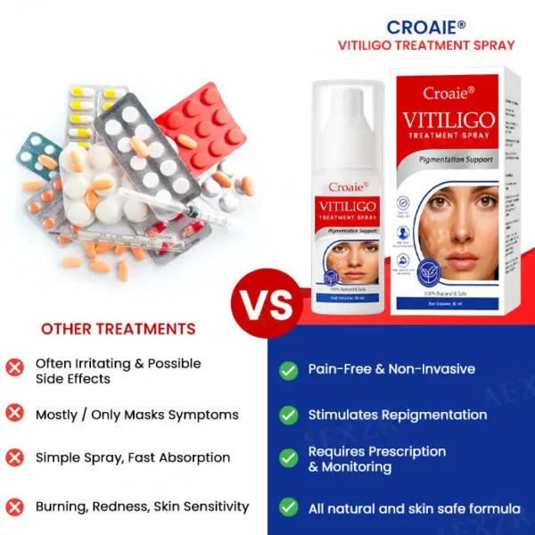 Croaie® Vitiligo Treatment Spray