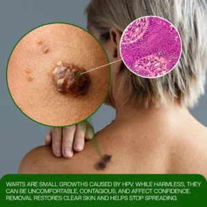 Euptate® ClinixClear Wart Remover Patch