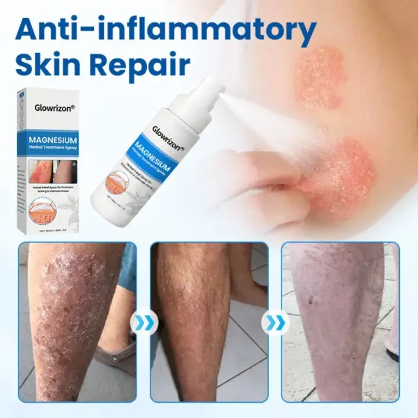 Glowrizon® Magnesium Herbal Treatment Spray