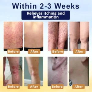 LOVILDS® Psoriasis Care Mellifera Venom Skin Healing Spray🐝〰️