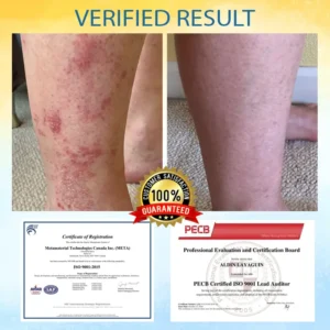 LOVILDS® Psoriasis Care Mellifera Venom Skin Healing Spray🐝〰️