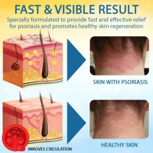 LOVILDS® Psoriasis Care Mellifera Venom Skin Healing Spray🐝〰️