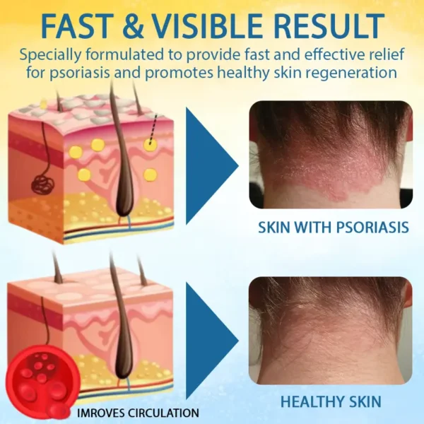 LOVILDS® Psoriasis Care Mellifera Venom Skin Healing Spray🐝〰️