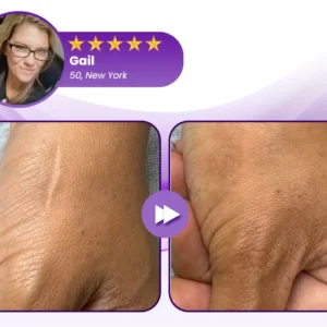 LOVILDS® RevivaDerma Face & Body Scar Gel