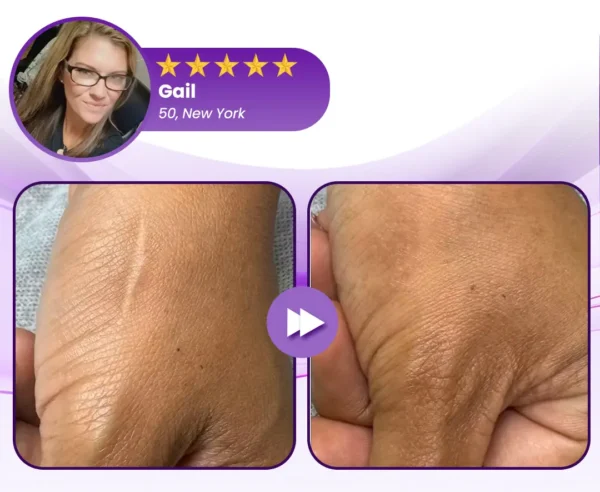 LOVILDS® RevivaDerma Face & Body Scar Gel