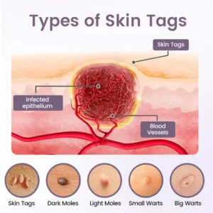 LOVILDS® Wart Smooth Renewal Serum