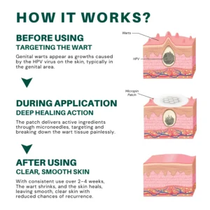 Alisanda™ Magnesium MicroPin HPV Genital Wart Removal Patch