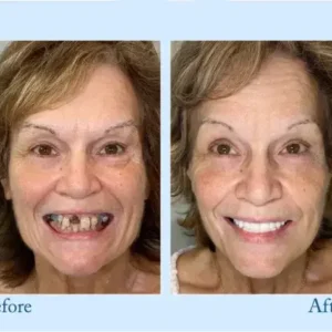 Hidone™ – Premium-Zahnprothese