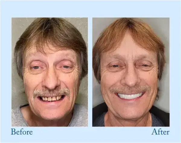 Hidone™ – Premium-Zahnprothese